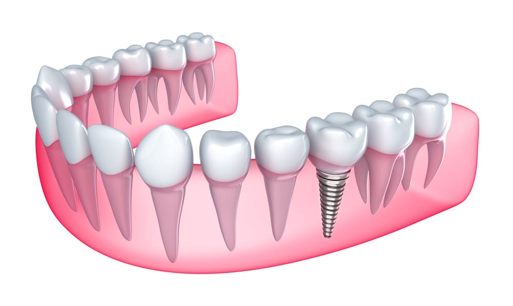dental implant procedure