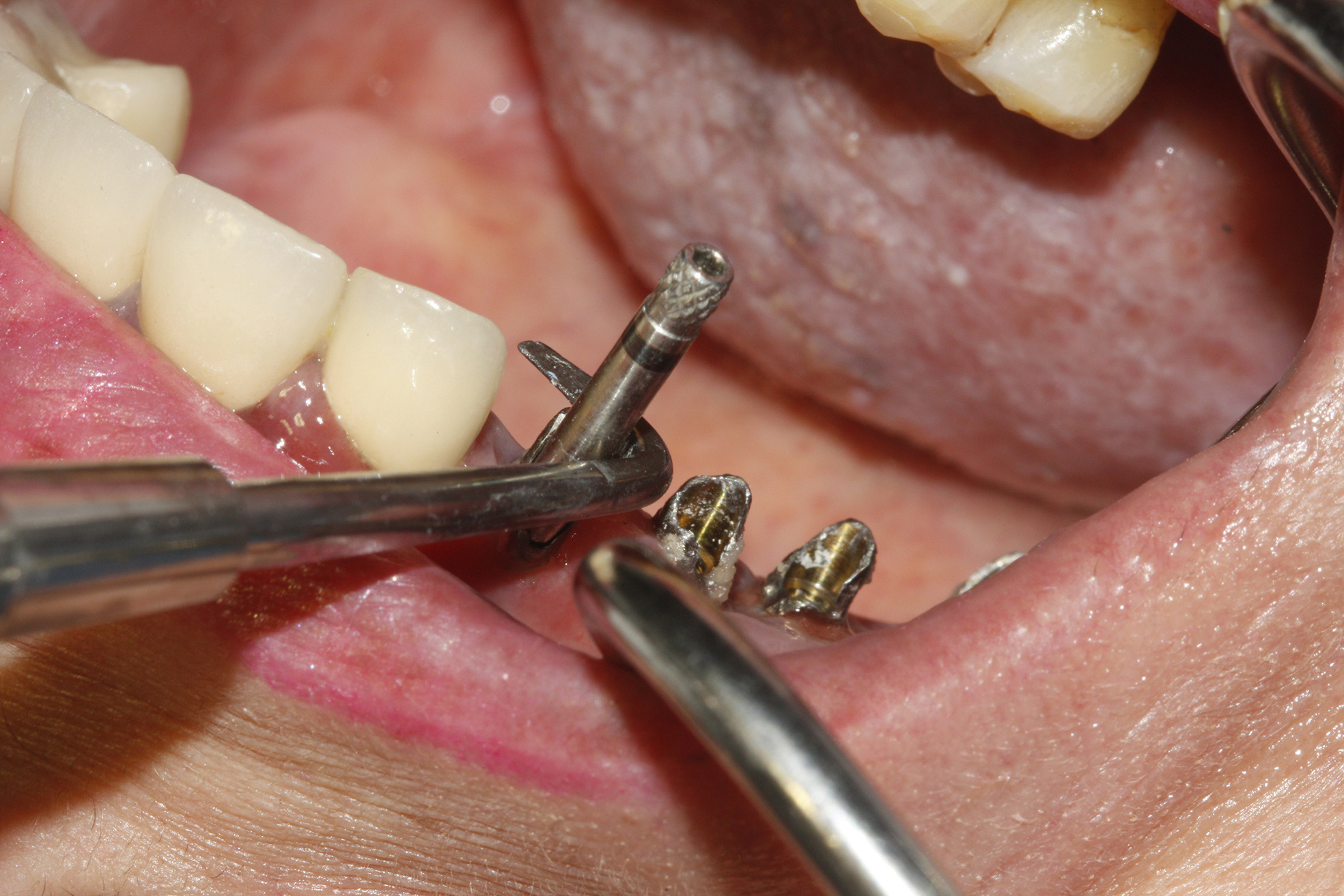 dental implants removal
