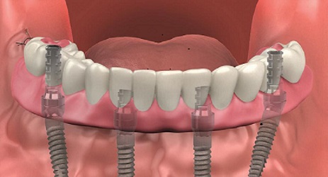 full dental implants cost