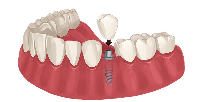 Dental Implant Solutions