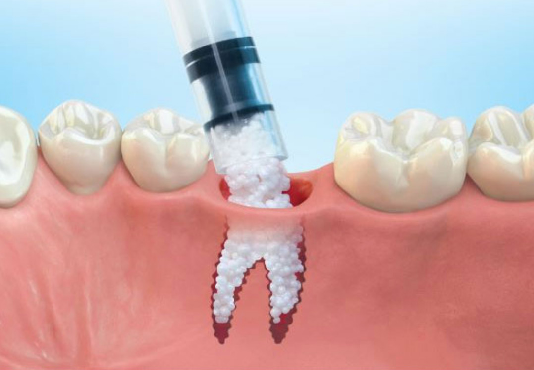 dental bone grafting procedure