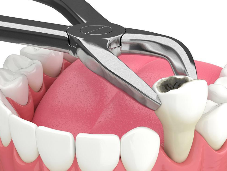 tooth extractions and dentures