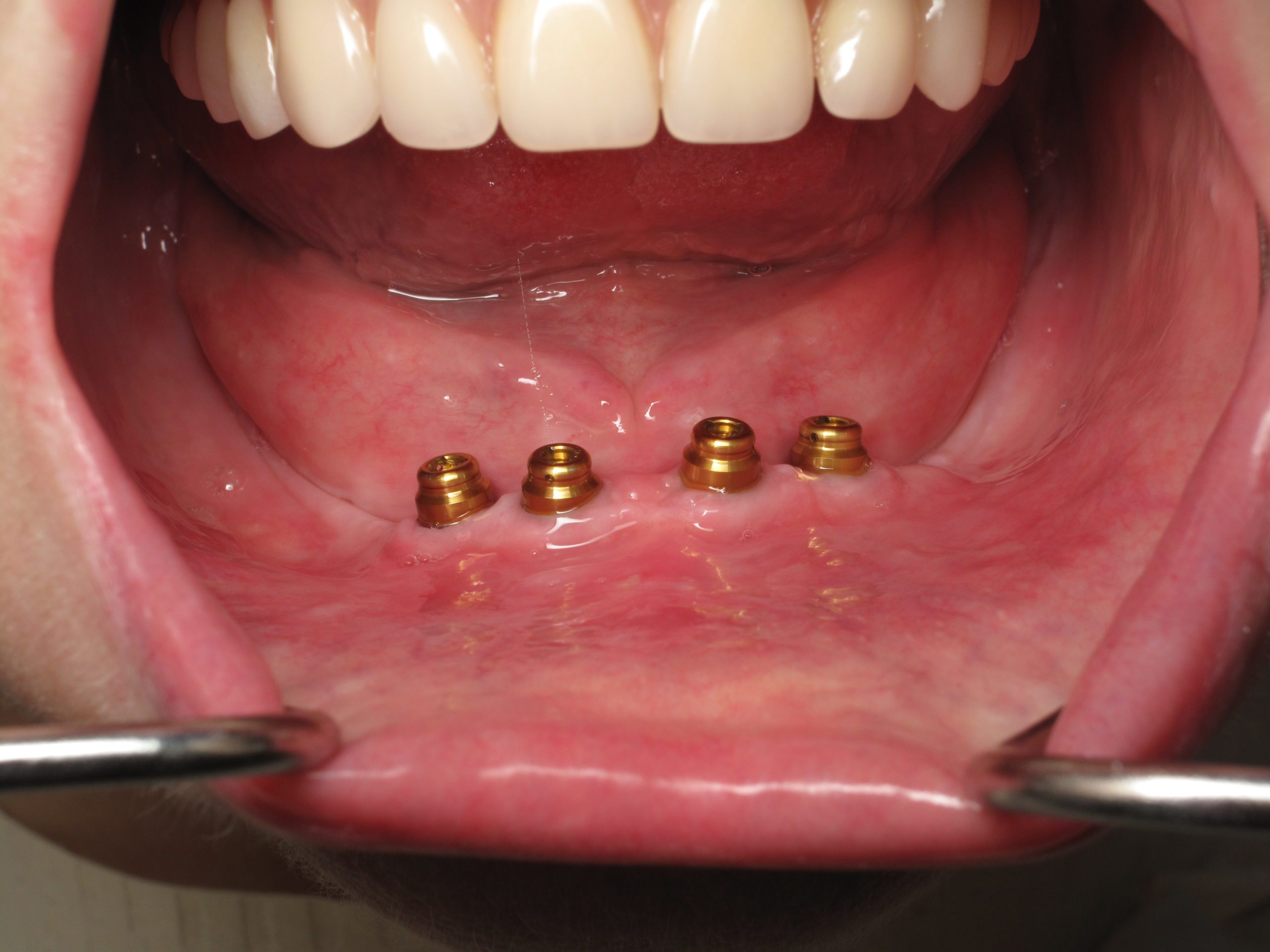 Dental Implants Near Me