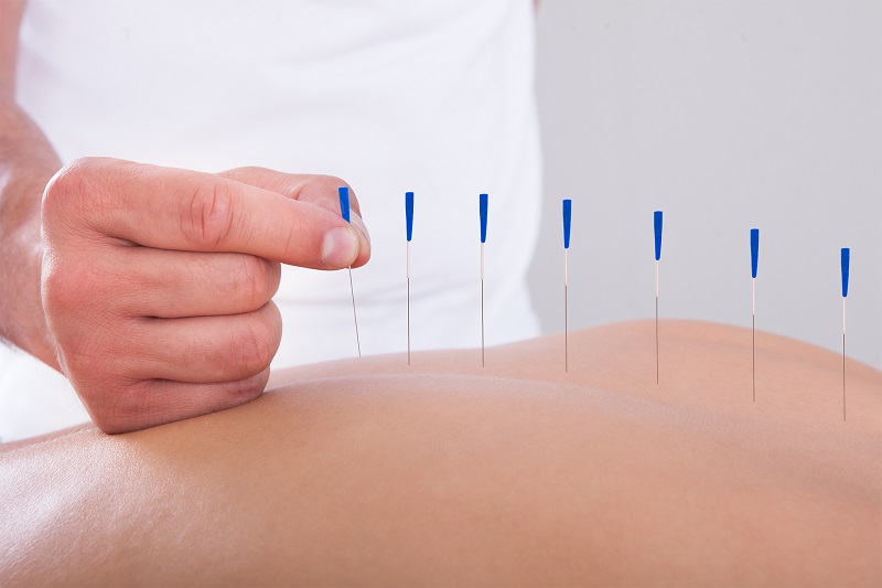 acupuncture in sherwood park